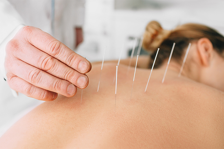 Benefits Of An Acupuncture Points Chart